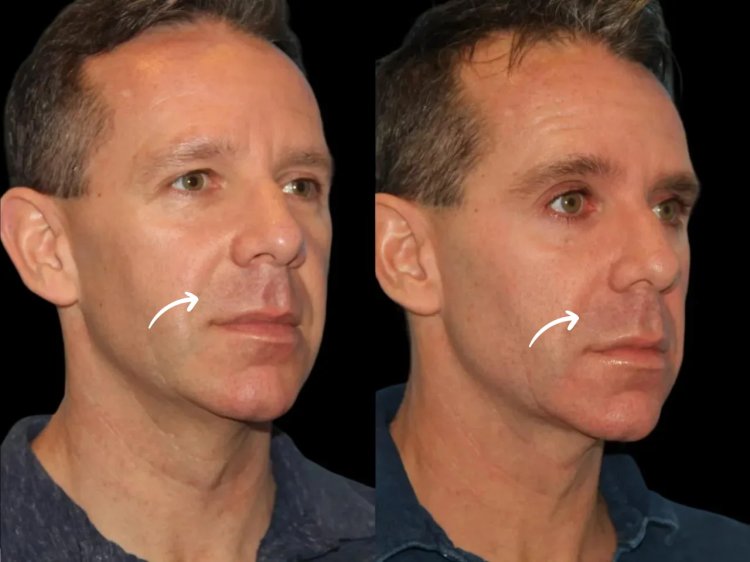 The Role of Sculptra Fillers Treatment in Dubai for Enhancing Chin Projections